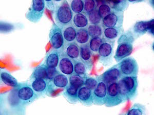 cancer-cell4.jpg